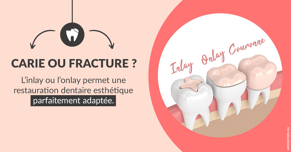 https://selarl-cabinet-orthodontie-mh-preve.chirurgiens-dentistes.fr/T2 2023 - Carie ou fracture 2