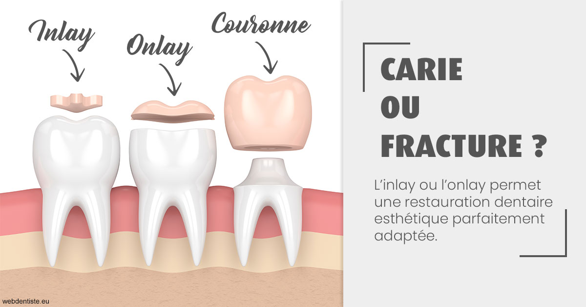 https://selarl-cabinet-orthodontie-mh-preve.chirurgiens-dentistes.fr/T2 2023 - Carie ou fracture 1