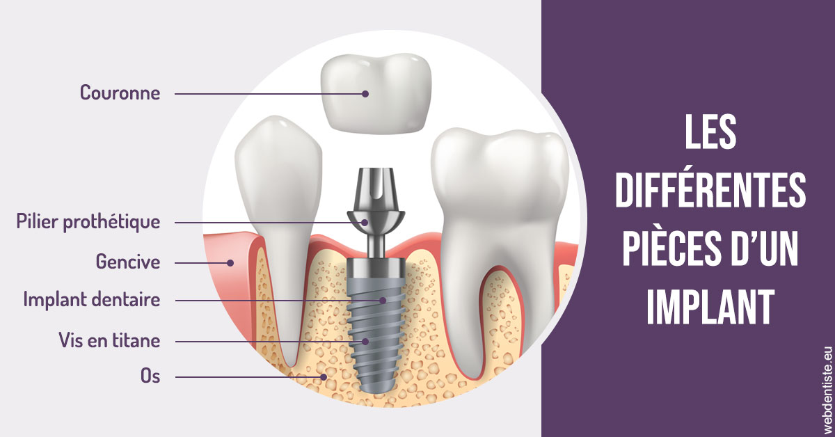 https://selarl-cabinet-orthodontie-mh-preve.chirurgiens-dentistes.fr/Les différentes pièces d’un implant 2