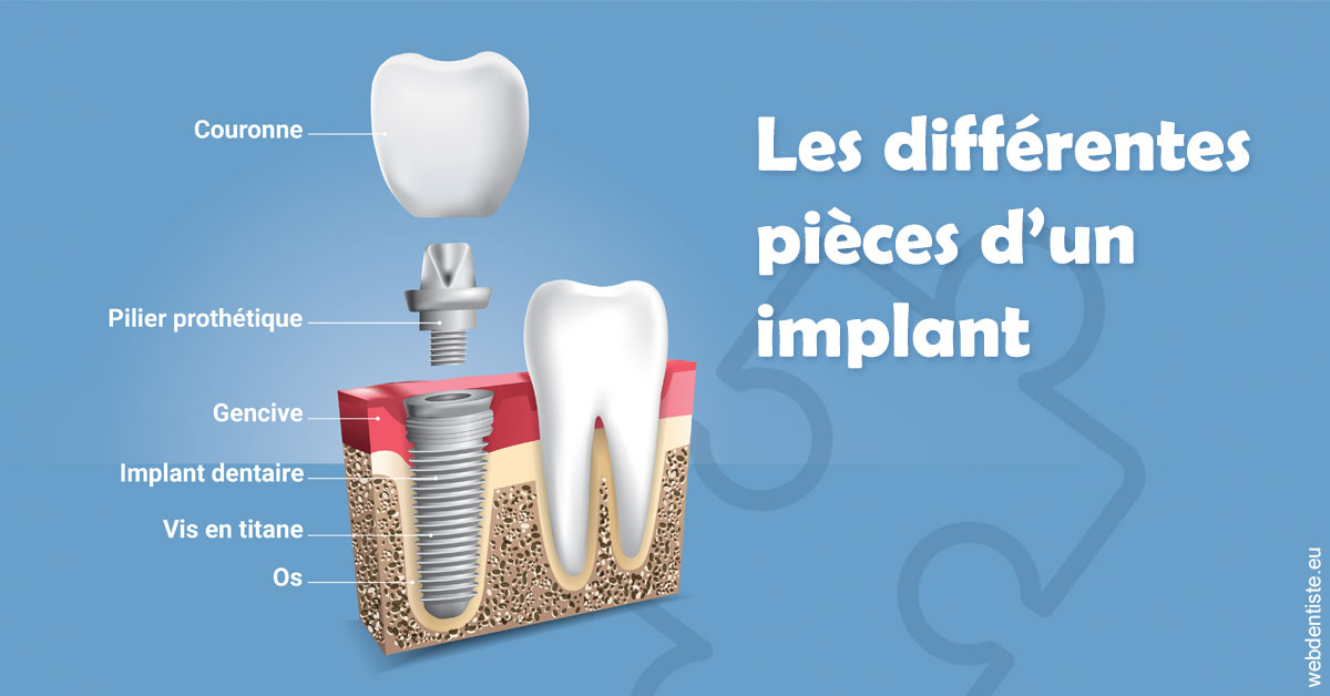 https://selarl-cabinet-orthodontie-mh-preve.chirurgiens-dentistes.fr/Les différentes pièces d’un implant 1